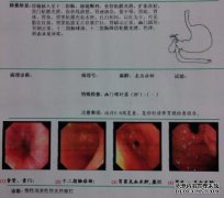 如何区分胃癌和胃炎