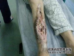 我怀疑是骨髓炎，我该怎么办？