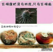 [宫颈糜烂]什么是宫颈糜烂？