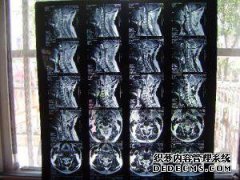 什么是宫颈沉降？