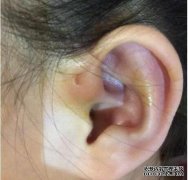婴儿的耳朵外侧有一个小孔，老人的耳朵发炎（