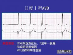 rr间隔是什么意思？