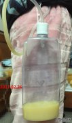 什么是先天性乳糜乳房？