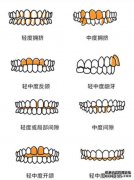 一个典型的箍要多少钱？