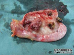什么是子宫颈胶囊？我需要手术吗？