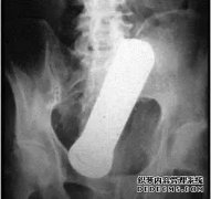 女性抗菌乳液是否在阴道中冲洗过？它仍然插入
