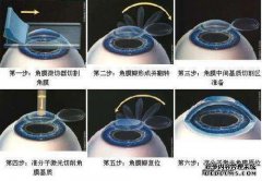 减少旋转和滴水！用微创激光刀治疗肺癌更准确