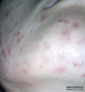 仅使眉毛折断的痤疮是不够的。脓破了。脓破了